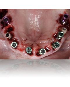 Treatment of Terminal Dentition Using Analog/Hybrid Implant Treatment Workflow (402) - Las Vegas, NV
