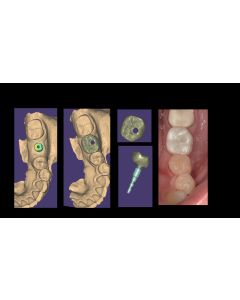 Digital Implant Dentistry from Planning to Implementation (202) - Las Vegas, NV