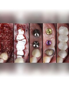 Getting Started in Implant Dentistry