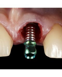 Immediate Implant Placement and Provisionalization- Orlando, FL